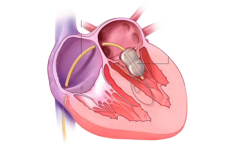 Balloon Mitral Valvotomy