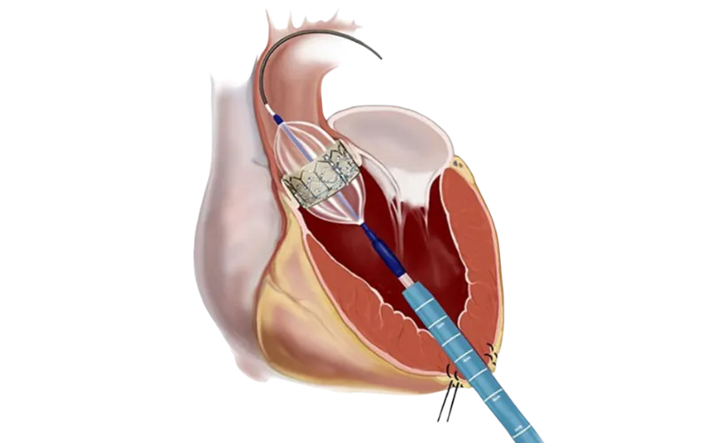 Balloon Pulmonary Valvotomy
