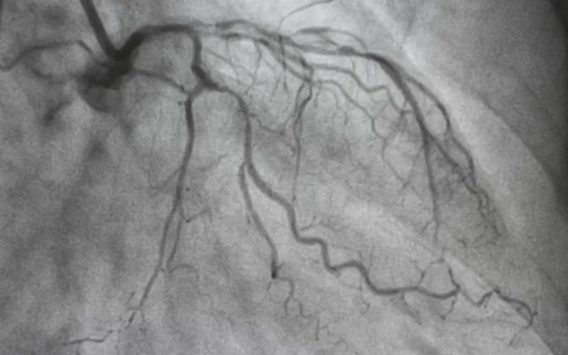 Coronary Angioplasty