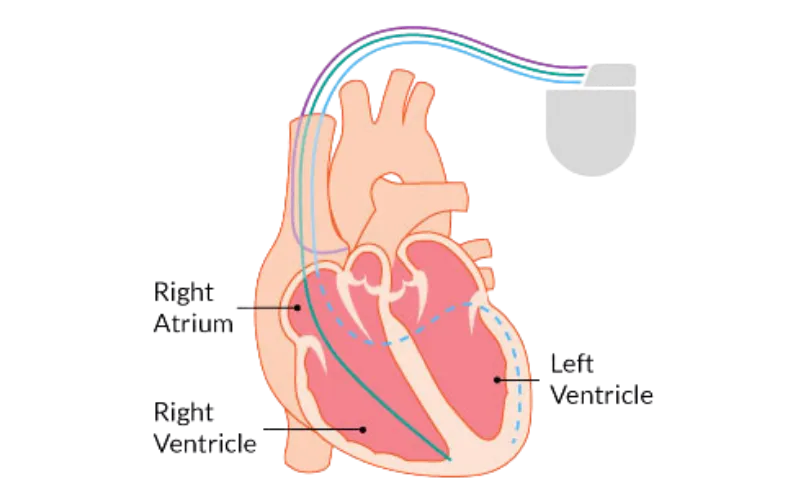 CRT-D Implantation
