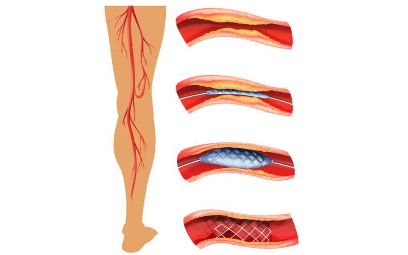 Peripheral Angioplasty and Stenting