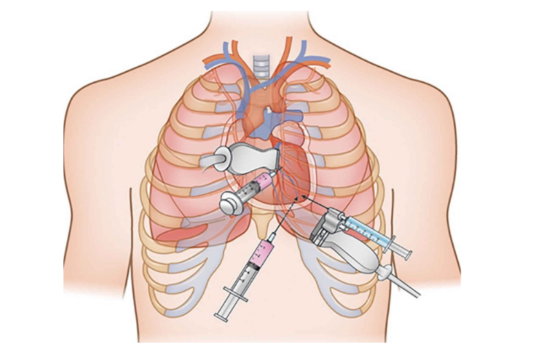 Pericardiocentesis