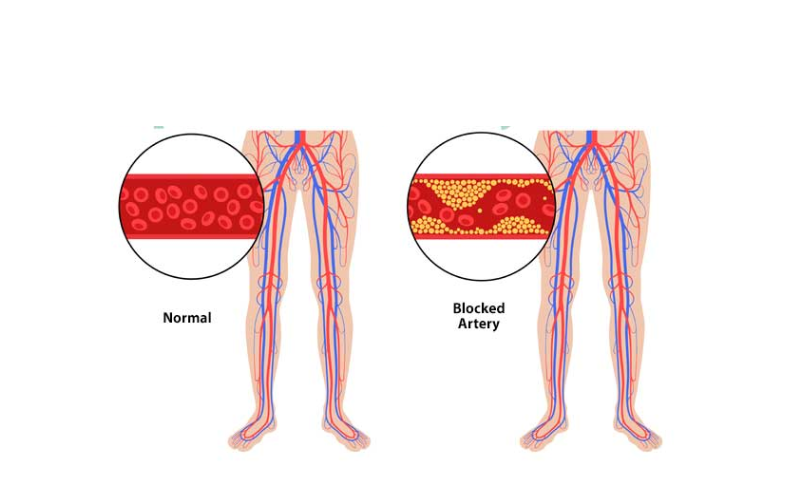 Peripheral Angiography