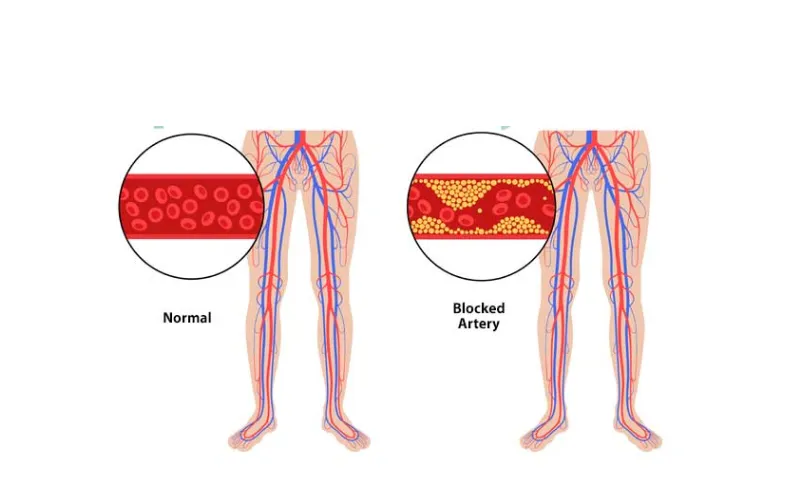 Peripheral Angiography